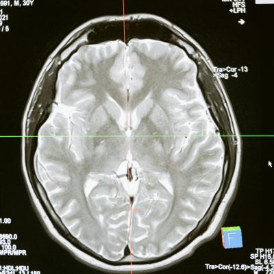 Trauma, Head Injury, and FND